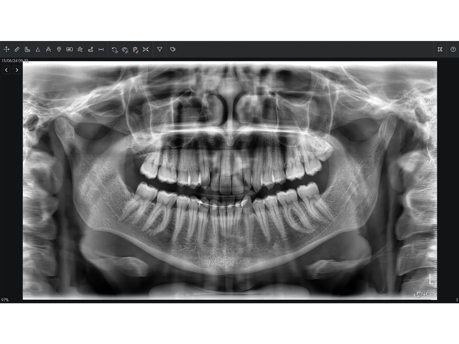 X9_fullview_obs_05